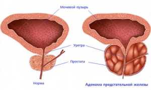 Каковы симптомы аденомы простаты у мужчин и лечение ее препаратами
