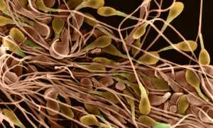 Полизооспермия: причины развития, лечение