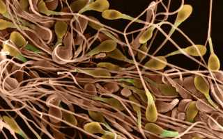 Полизооспермия: причины развития, лечение