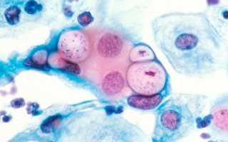 Как лечить проявления хламидиоза у мужчин?