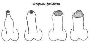 Симптомы и методы лечения разных степеней фимоза