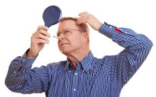 Почему у мужчин выпадают волосы на голове?