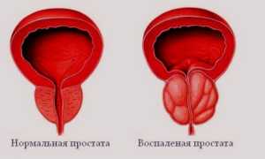 Лечится ли хронический простатит
