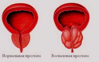 Лечится ли хронический простатит