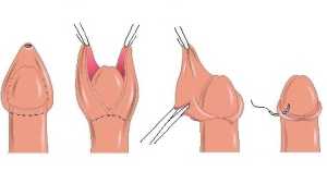 Как должно происходить заживление после обрезания?