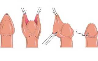 Как должно происходить заживление после обрезания?