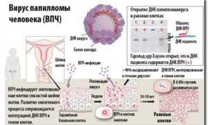 Диагностика и лечение папилломавирусной инфекции у мужчин