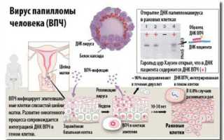 Диагностика и лечение папилломавирусной инфекции у мужчин