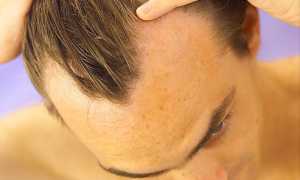 Что необходимо знать про выпадение волос у мужчин?