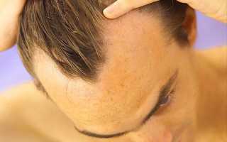 Что необходимо знать про выпадение волос у мужчин?