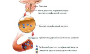 Что поможет установить онкомаркер ПСА: норма