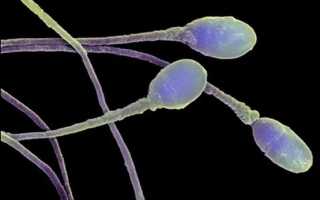 Выявление причин бесплодия с помощью расширенной спермограммы