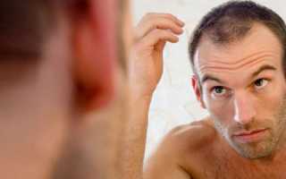 Ранняя лысина у мужчин: причины и лечение