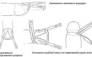 Чем нужно обрабатывать рану после обрезания?