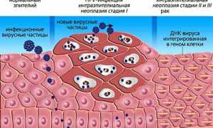 Как проявляется заболевание ВПЧ 31 типа у мужчин?