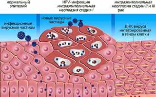 Как проявляется заболевание ВПЧ 31 типа у мужчин?