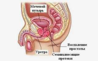 Хронический простатит и бесплодие: их взаимосвязь и последствия
