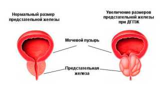Обзор современных препаратов от простатита
