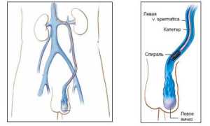 Лечение варикоцеле