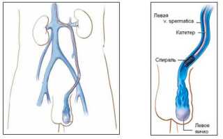 Лечение варикоцеле