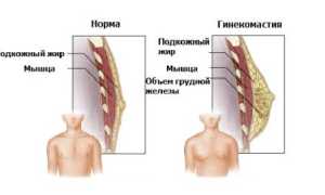 Как уменьшить с помощью пластики и занятий грудь у мужчин?