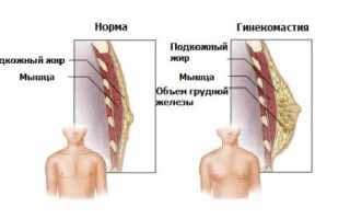 Как уменьшить с помощью пластики и занятий грудь у мужчин?