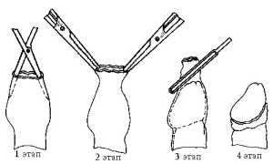 Показания к удалению крайней плоти у мужчин