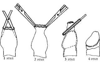 Показания к удалению крайней плоти у мужчин