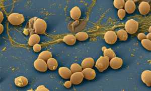 Причины и признаки молочницы у мужчин