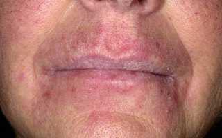 Что вызывает покраснение кожи лица у мужчин?
