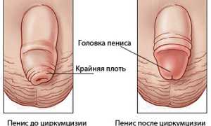 Обрезание у взрослых мужчин: больно ли это?