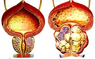 Как развивается аденома простаты?