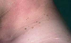 Почему появляются папилломы на шее у мужчин