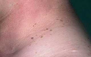 Почему появляются папилломы на шее у мужчин