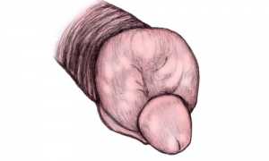 Почему возникает отёк полового члена?