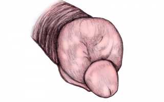 Почему возникает отёк полового члена?