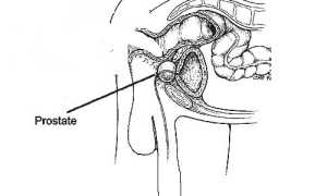 Берут ли в армию на срочную службу с простатитом?