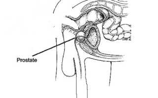 Берут ли в армию на срочную службу с простатитом?