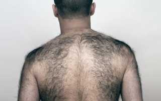 Причины появления волос на спине у мужчин