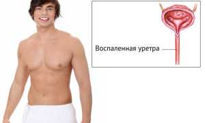 В чем причины появления крови из уретры у мужчин?