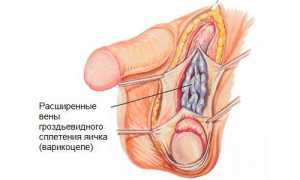 Лучший метод хирургического лечения варикоцеле — операция Мармара