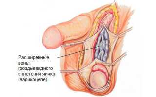 Лучший метод хирургического лечения варикоцеле — операция Мармара
