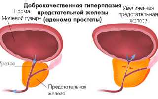 Аденома простаты у мужчин: лечение без операции