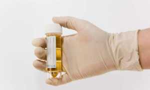 Выявленный белок в моче у мужчин: что это значит?