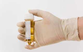 Выявленный белок в моче у мужчин: что это значит?