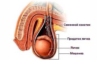 Лечение воспаления семенного канатика и симптомы заболевания