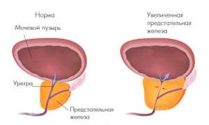 Лечение доброкачественной гиперплазии предстательной железы — ДГПЖ 2 степени