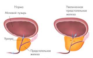 Лечение доброкачественной гиперплазии предстательной железы — ДГПЖ 2 степени