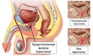 Рак предстательной железы: стадии заболевания и прогноз