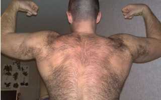 Как проявляется избыток тестостерона у мужчин?